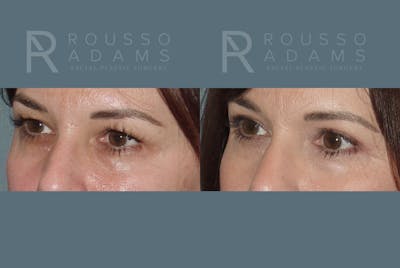 Blepharoplasty Before & After Gallery - Patient 146647275 - Image 2