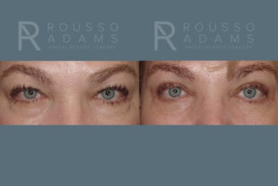 Blepharoplasty<span class=small>By Dr. Austin Adams</span> Before & After Gallery - Patient 146647276 - Image 1