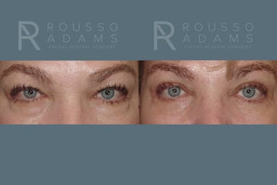 Blepharoplasty Before & After Gallery - Patient 146647276 - Image 1