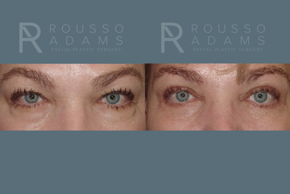 Blepharoplasty Before & After Gallery - Patient 146647276 - Image 1