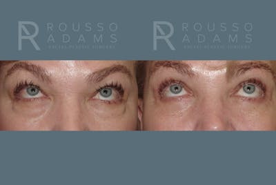 Blepharoplasty<span class=small>By Dr. Austin Adams</span> Before & After Gallery - Patient 146647276 - Image 2