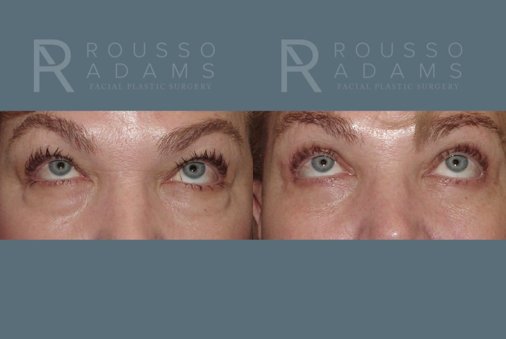 Blepharoplasty Before & After Gallery - Patient 146647276 - Image 2