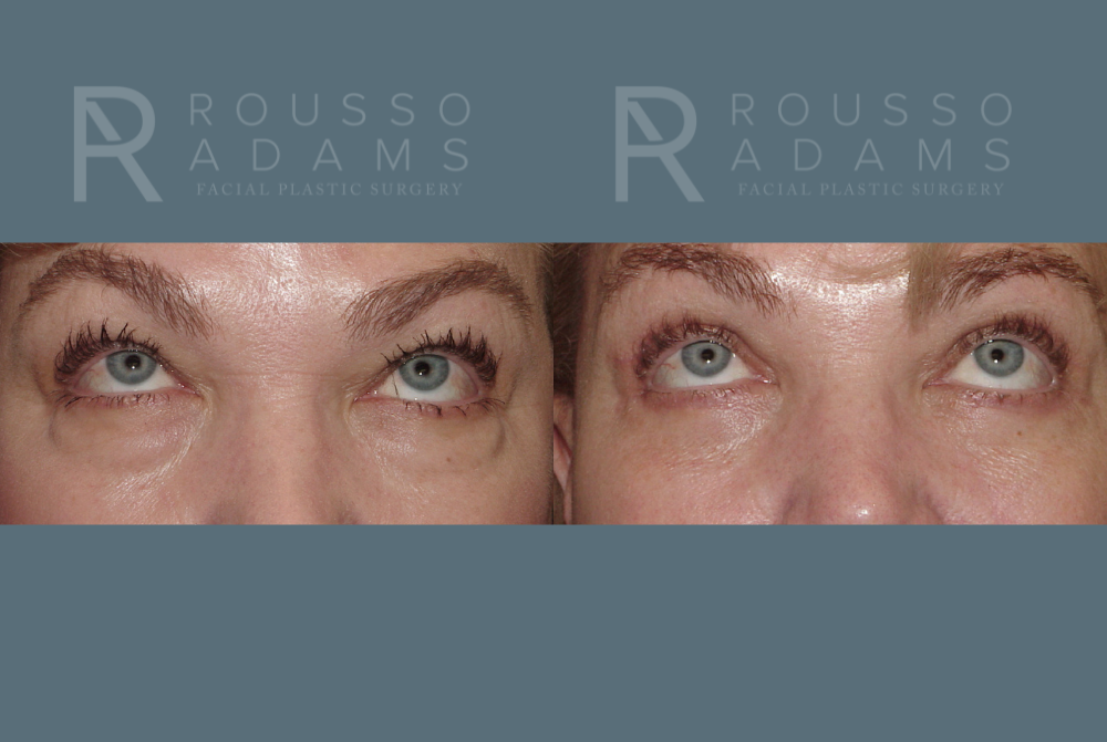 Blepharoplasty<span class=small>By Dr. Austin Adams</span> Before & After Gallery - Patient 146647276 - Image 2