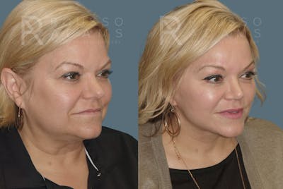 Facelift <span class=small>By Dr. Austin Adams</span> Before & After Gallery - Patient 146646985 - Image 1