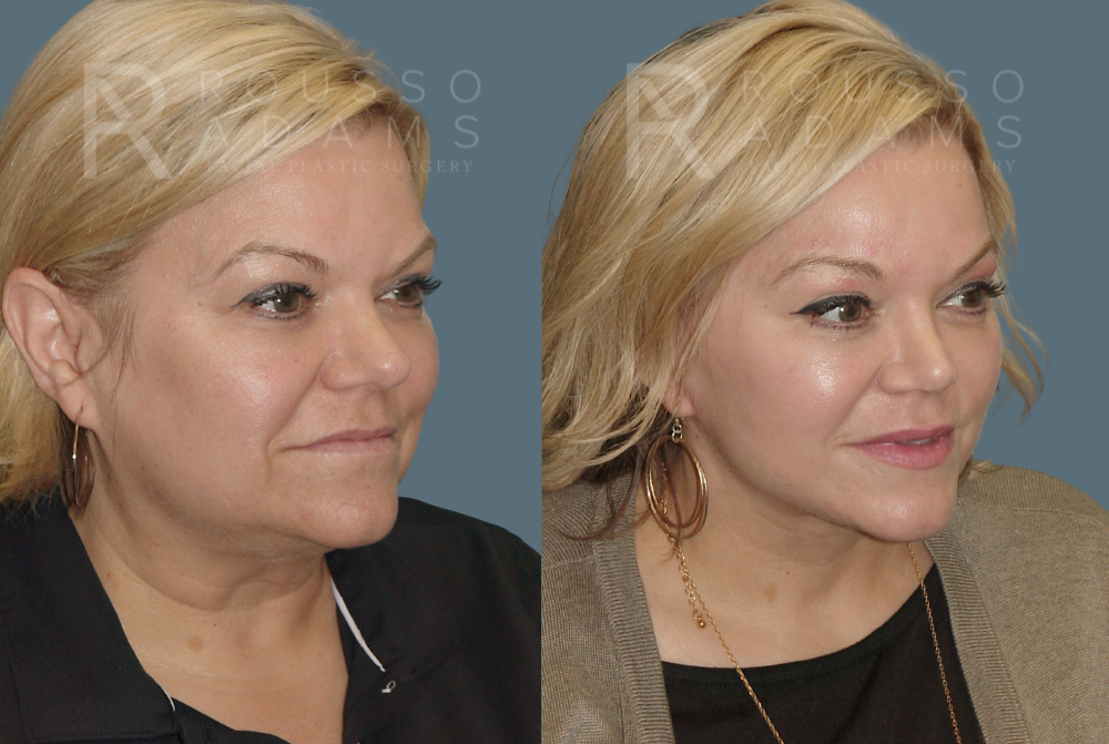 Facelift <span class=small>By Dr. Austin Adams</span> Before & After Gallery - Patient 146646985 - Image 1