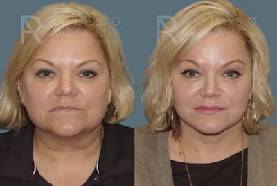 SculptLift™<span class=small>By Dr. Austin Adams</span> Before & After Gallery - Patient 146647154 - Image 1