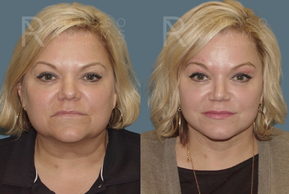 Facelift <span class=small>By Dr. Austin Adams</span> Before & After Gallery - Patient 146646985 - Image 2