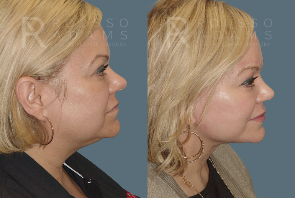 Facelift Before & After Gallery - Patient 146646985 - Image 3