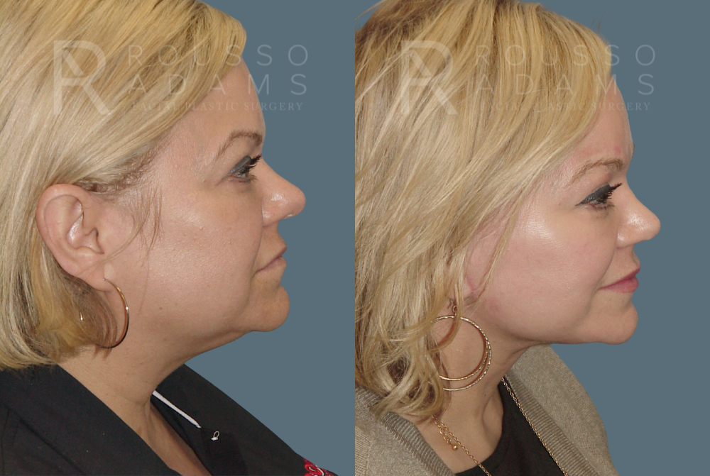 Facelift <span class=small>By Dr. Austin Adams</span> Before & After Gallery - Patient 146646985 - Image 3
