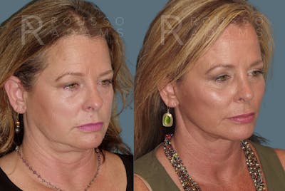 Facelift Before & After Gallery - Patient 146646986 - Image 1