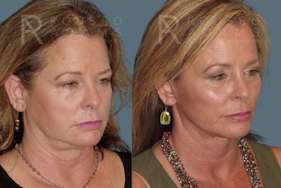 Facelift <span class=small>By Dr. Austin Adams</span> Before & After Gallery - Patient 146646986 - Image 1