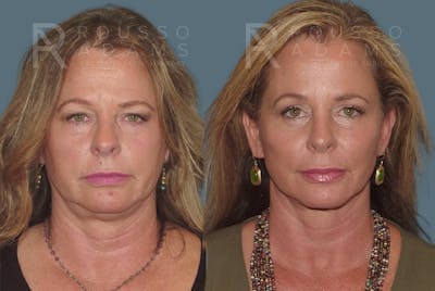 SculptLift™<span class=small>By Dr. Austin Adams</span> Before & After Gallery - Patient 146647155 - Image 1