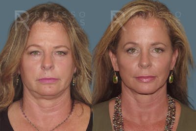 Facelift Before & After Gallery - Patient 146646986 - Image 2