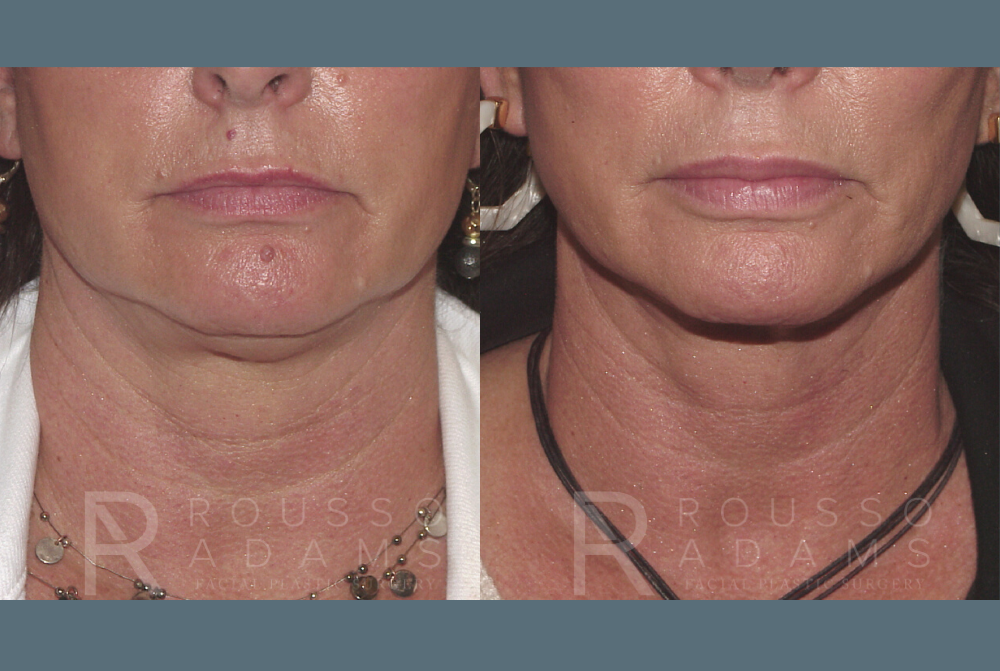 Facelift <span class=small>By Dr. Austin Adams</span> Before & After Gallery - Patient 146646986 - Image 3