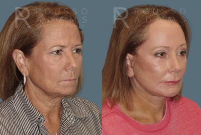 SculptLift™<span class=small>By Dr. Austin Adams</span> Before & After Gallery - Patient 146647156 - Image 2