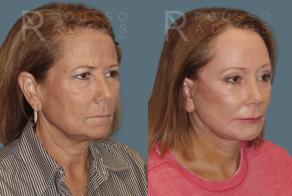SculptLift™ Before & After Gallery - Patient 146647156 - Image 2