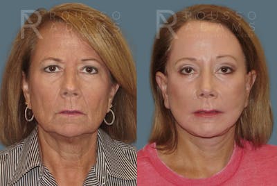 SculptLift™ Before & After Gallery - Patient 146647156 - Image 1