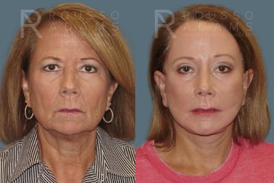 SculptLift™<span class=small>By Dr. Austin Adams</span> Before & After Gallery - Patient 146647156 - Image 1