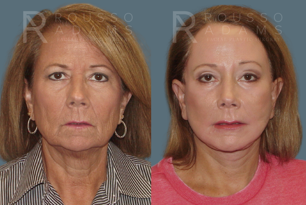 SculptLift™ Before & After Gallery - Patient 146647156 - Image 1