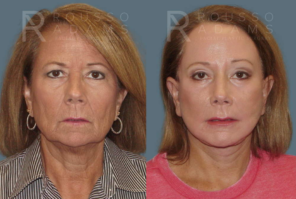 SculptLift™<span class=small>By Dr. Austin Adams</span> Before & After Gallery - Patient 146647156 - Image 1