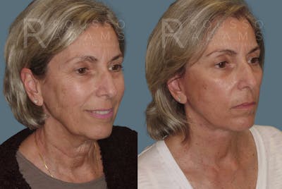 Facelift Before & After Gallery - Patient 146646988 - Image 1