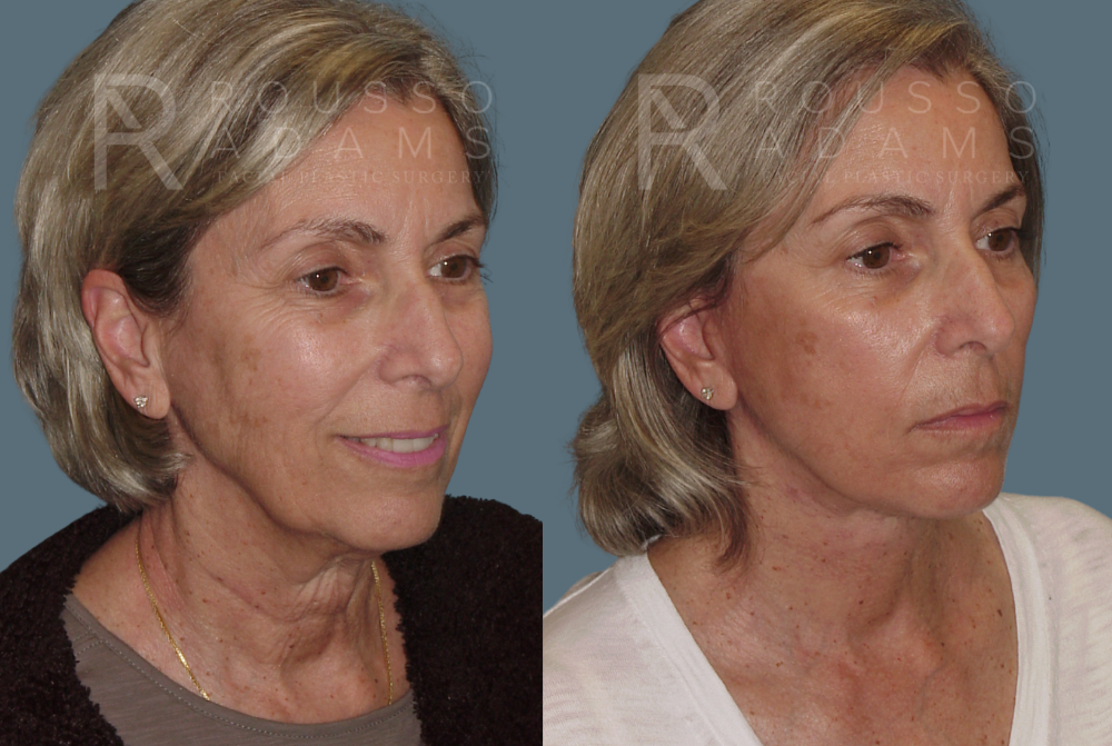 Facelift <span class=small>By Dr. Austin Adams</span> Before & After Gallery - Patient 146646988 - Image 1