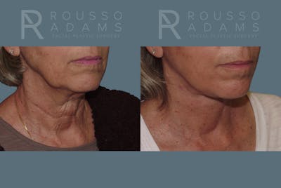 Facelift <span class=small>By Dr. Austin Adams</span> Before & After Gallery - Patient 146646988 - Image 2