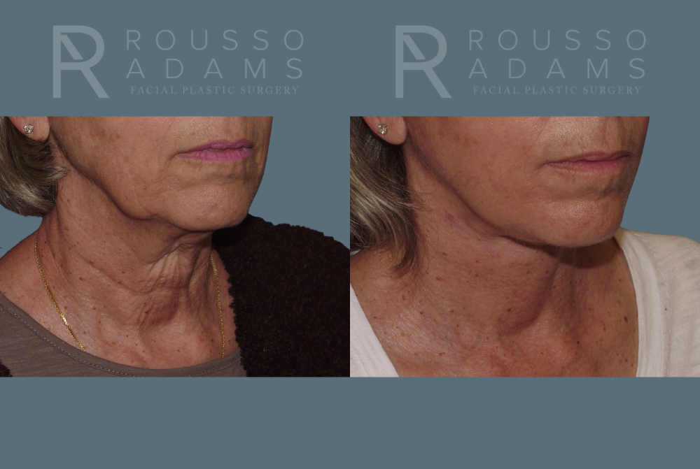 Facelift <span class=small>By Dr. Austin Adams</span> Before & After Gallery - Patient 146646988 - Image 2