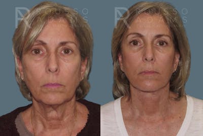 SculptLift™<span class=small>By Dr. Austin Adams</span> Before & After Gallery - Patient 146647157 - Image 1
