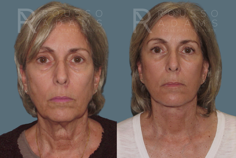 Facelift <span class=small>By Dr. Austin Adams</span> Before & After Gallery - Patient 146646988 - Image 3