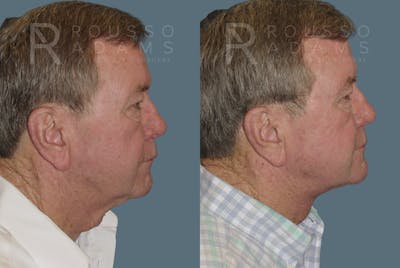 Male Facelift Before & After Gallery - Patient 146647034 - Image 2
