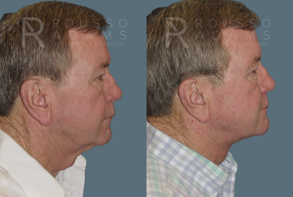 Male Facelift Before & After Gallery - Patient 146647034 - Image 2