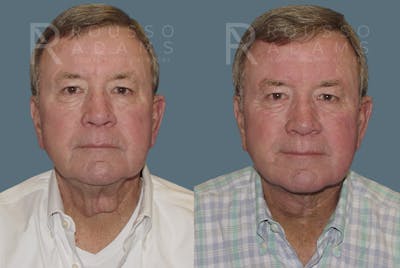 Male Facelift<span class=small>By Dr. Austin Adams</span> Before & After Gallery - Patient 146647034 - Image 1