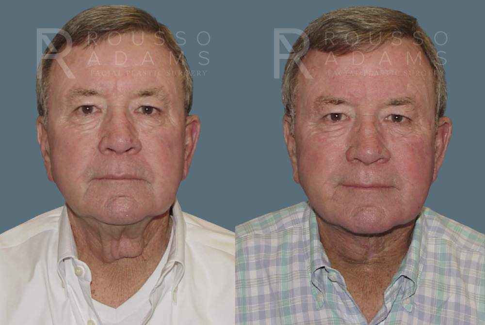 Facelift Before & After Gallery - Patient 146646989 - Image 2