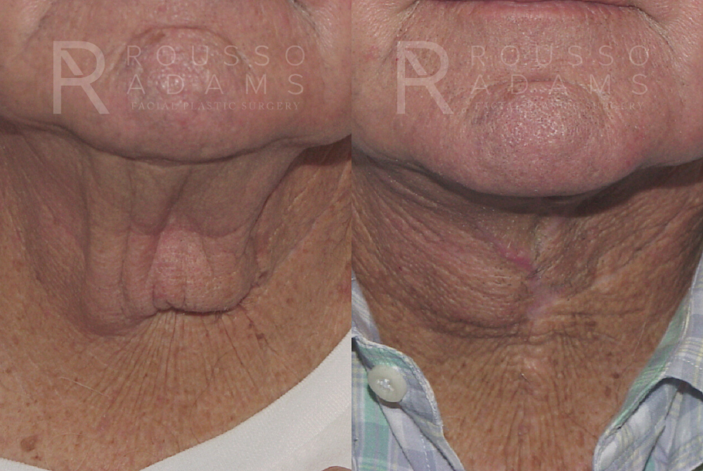 Male Facelift Before & After Gallery - Patient 146647034 - Image 3