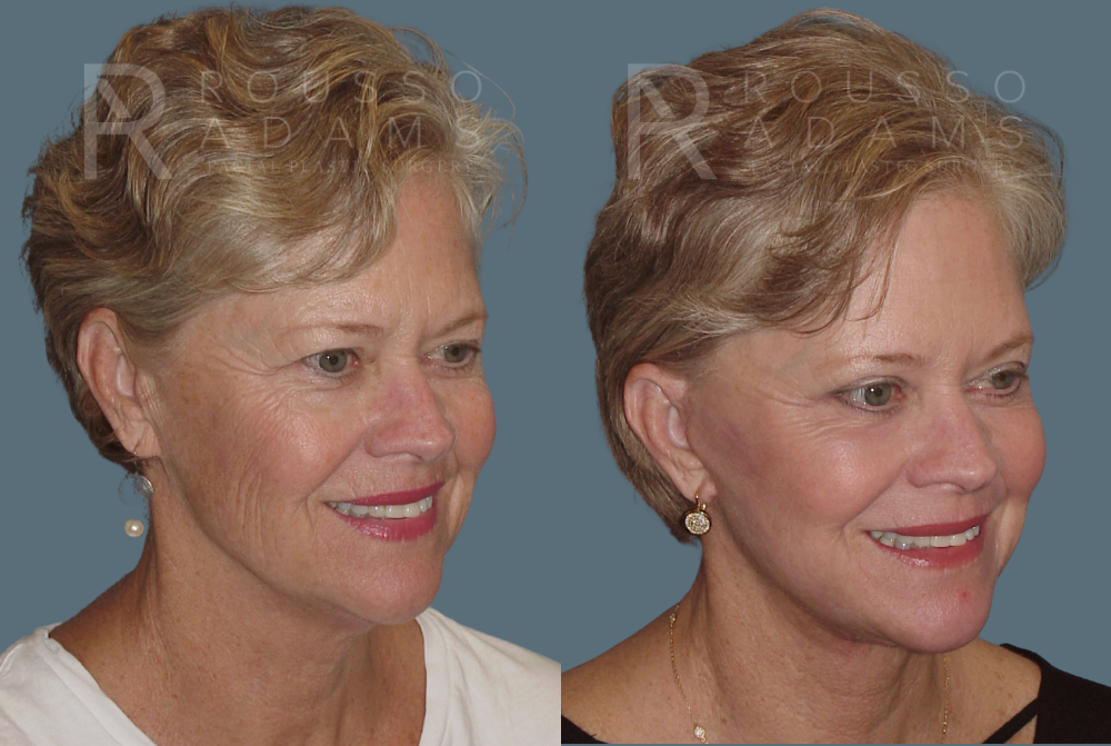 Facelift <span class=small>By Dr. Austin Adams</span> Before & After Gallery - Patient 146646990 - Image 1