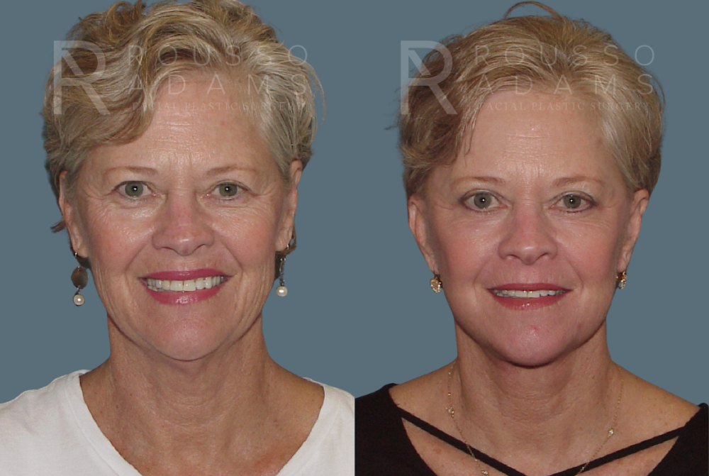 Facelift <span class=small>By Dr. Austin Adams</span> Before & After Gallery - Patient 146646990 - Image 2