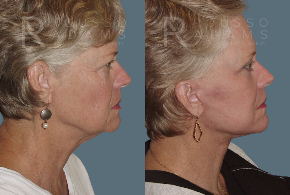 Facelift <span class=small>By Dr. Austin Adams</span> Before & After Gallery - Patient 146646990 - Image 3