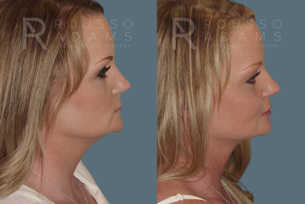 Facelift Before & After Gallery - Patient 146646991 - Image 2