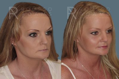 Facelift <span class=small>By Dr. Austin Adams</span> Before & After Gallery - Patient 146646991 - Image 1
