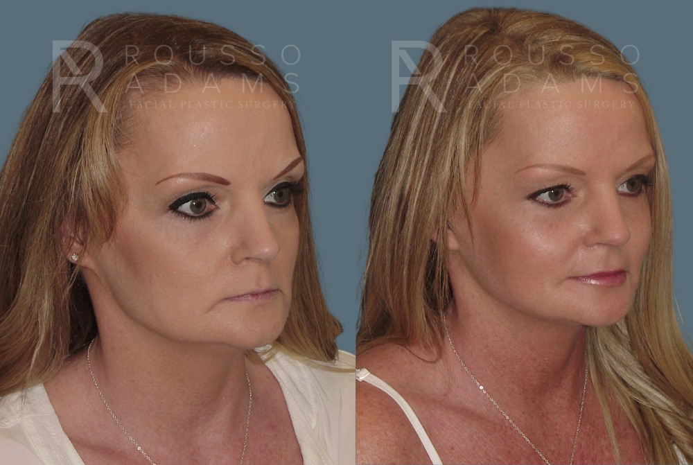 Facelift <span class=small>By Dr. Austin Adams</span> Before & After Gallery - Patient 146646991 - Image 1