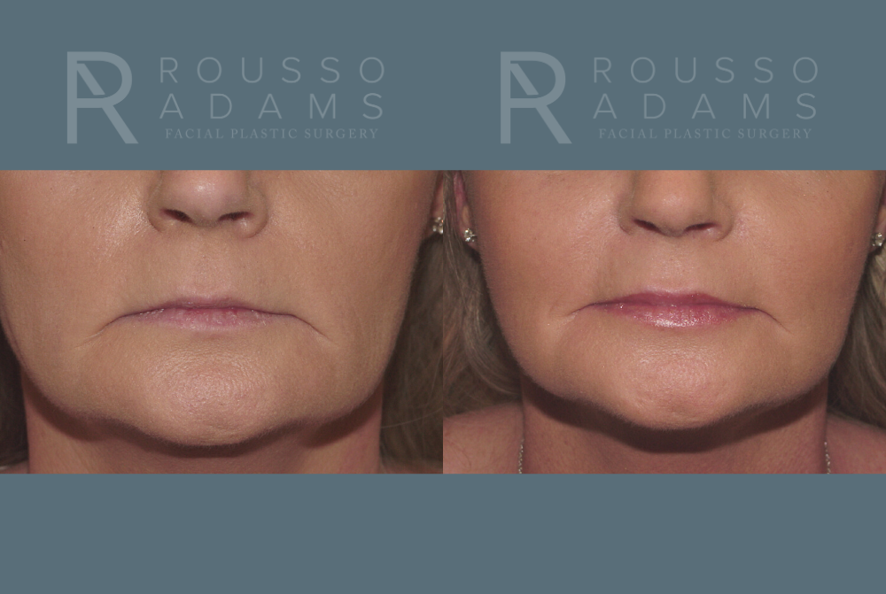 Facelift <span class=small>By Dr. Austin Adams</span> Before & After Gallery - Patient 146646991 - Image 3