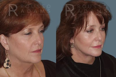 Facelift <span class=small>By Dr. Austin Adams</span> Before & After Gallery - Patient 146646992 - Image 1