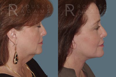 Facelift Before & After Gallery - Patient 146646992 - Image 2