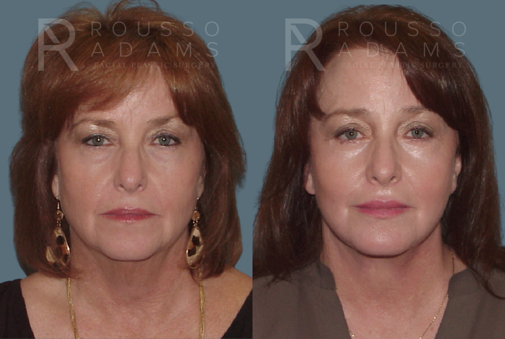 Facelift Before & After Gallery - Patient 146646992 - Image 3