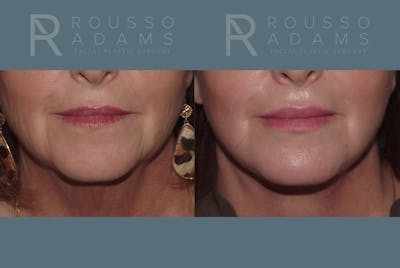 Facelift <span class=small>By Dr. Austin Adams</span> Before & After Gallery - Patient 146646992 - Image 4
