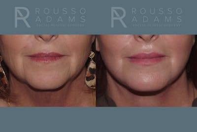 Facelift Before & After Gallery - Patient 146646992 - Image 4