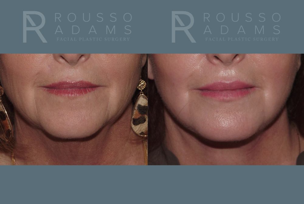 Facelift <span class=small>By Dr. Austin Adams</span> Before & After Gallery - Patient 146646992 - Image 4
