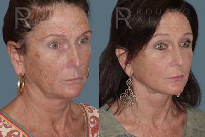 SculptLift™ Before & After Gallery - Patient 146647161 - Image 1