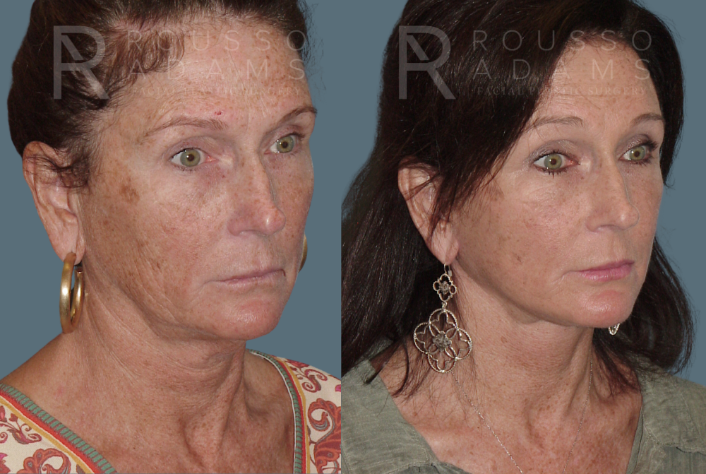 Facelift <span class=small>By Dr. Austin Adams</span> Before & After Gallery - Patient 146646993 - Image 1